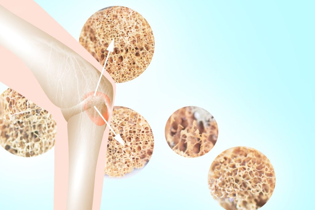 Illustration of a knee joint with arrows pointing to circular images of bone under a microscope. The close up images of bone show the very porous bone of someone with osteoperosis. 