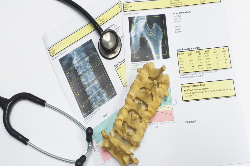 Overhead view of two medical documents that have the results of patients DEXA scan. The documents have x-ray images of a person's hip and spine in addition to a DEXA results summary. On top of the documents sits a model of human vertebrae and a stethoscope. 